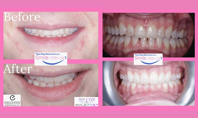 Composite Veneers - Before and After