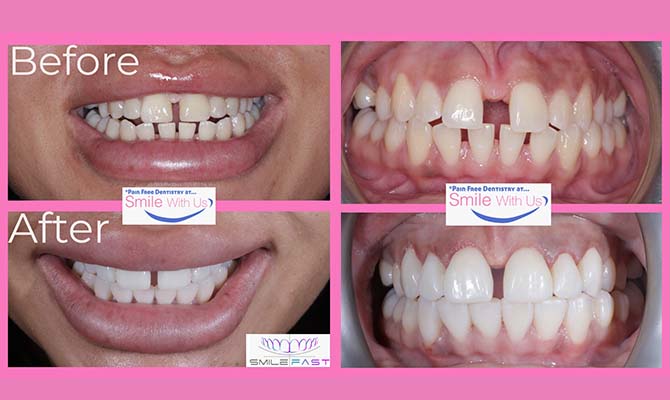 Composite Veneers - Before and After